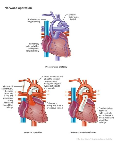 rv pa conduit stenosis.